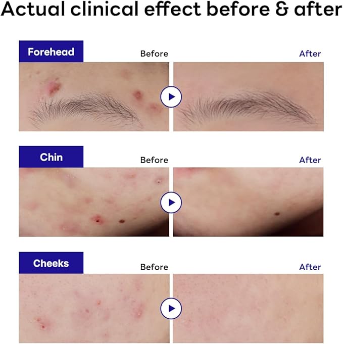 Mediheal Derma Clear Teatree Trouble Spot Patch 44 Patch Derma Clear Teatree Trouble Spot Patch 44 Patch