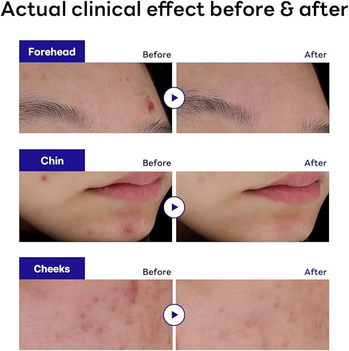 Mediheal  Derma Clear Madecassoside Blemish Spot 44 Patch